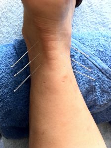 left ankle with three acupuncture needled in either side of the ankle one on a blue towel